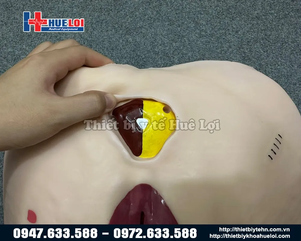 Vết thương và nấm Cadida của mô hình Chăm sóc vết thương cùng vùng cụ