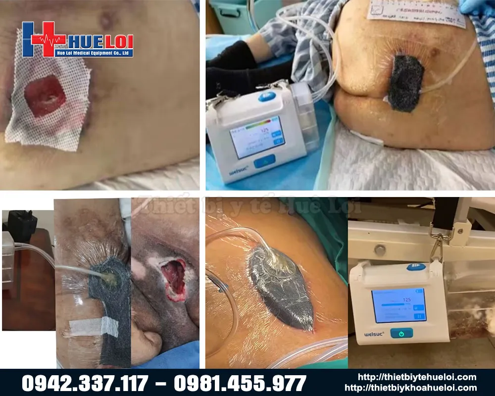 máy hút áp lực âm RH-1000 máy hút áp lực âm RH-1000