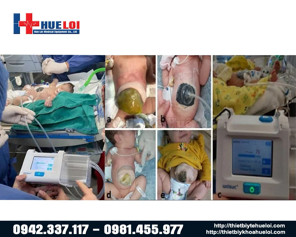 hình ảnh điều trị vết thương loét bằng máy RH-100 hình ảnh điều trị vết thương loét bằng máy RH-100