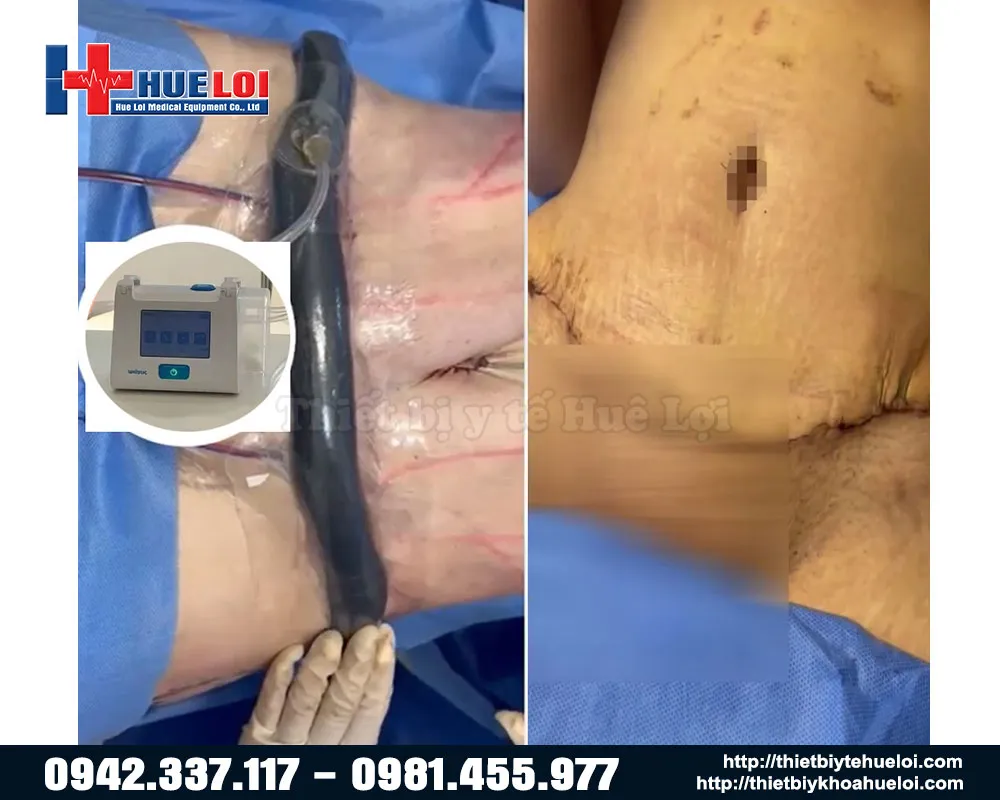 hình ảnh điều trị vết thương loét hình ảnh điều trị vết thương loét