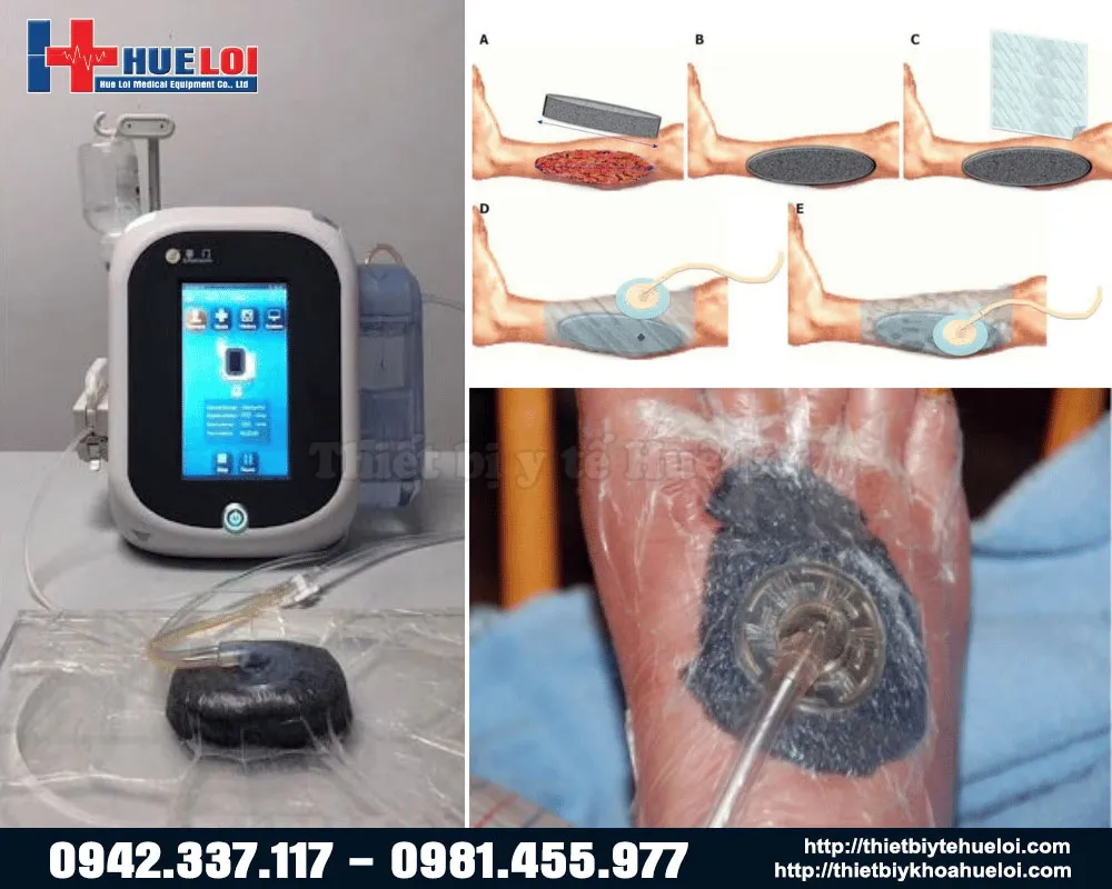 hình ảnh điều trị thực tế của máy NP-800 hình ảnh điều trị thực tế của máy NP-800