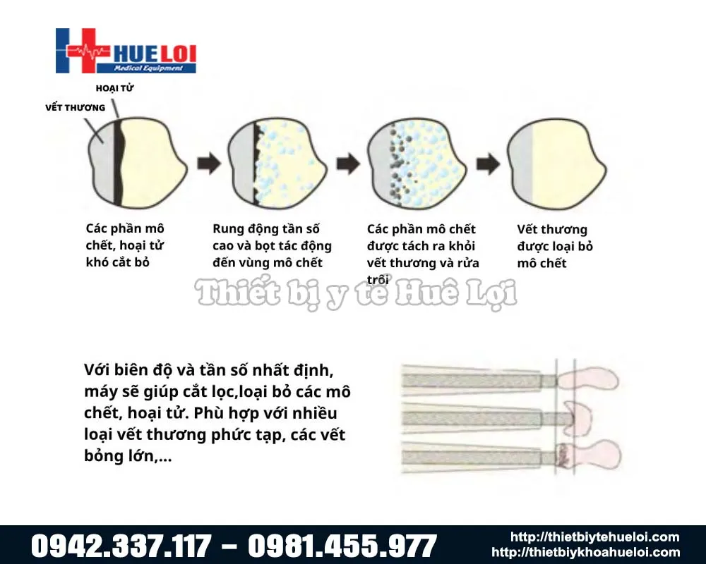 cơ chế vi bọt của máy siêu âm cắt bỏ vết thương cơ chế vi bọt của máy siêu âm cắt bỏ vết thương