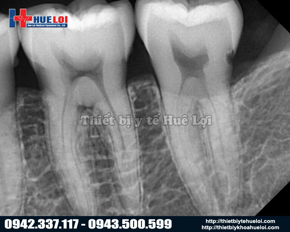 Hình ảnh sau khi chụp bằng máy X Quang di động