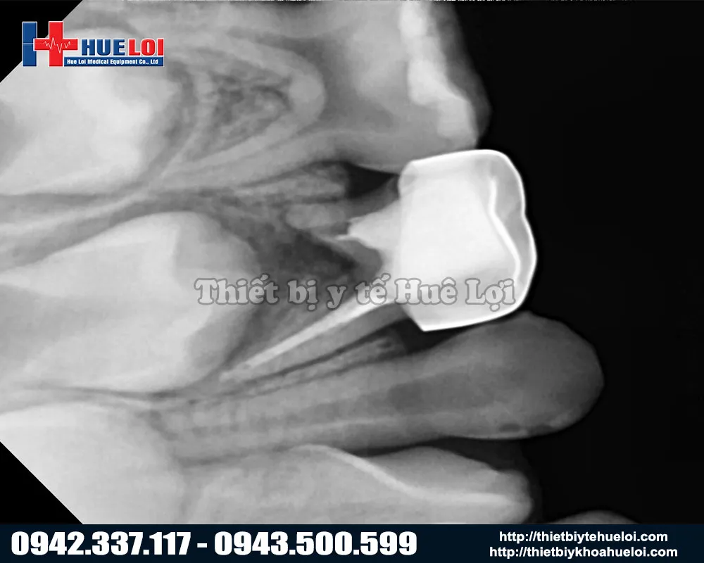 Kết quả khi chụp bằng máy X Quang nha khoa Vatech