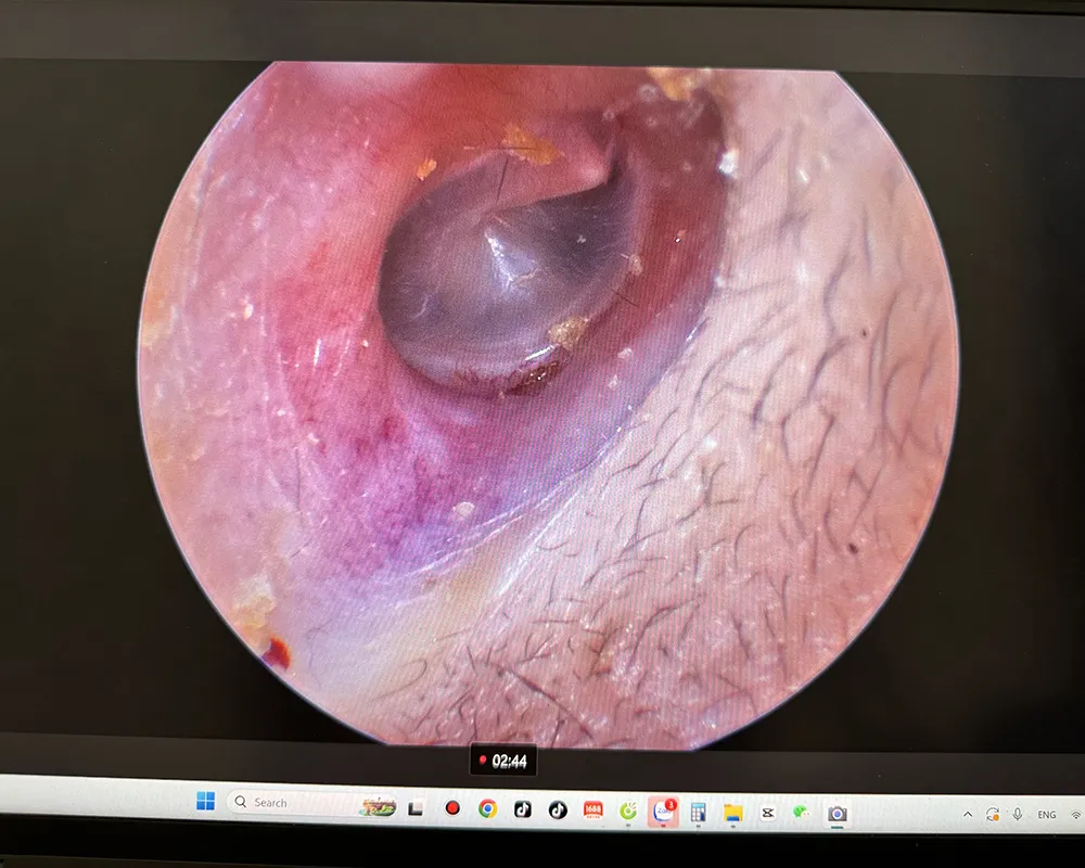 Hình ảnh của máy nội soi tai mũi họng mini