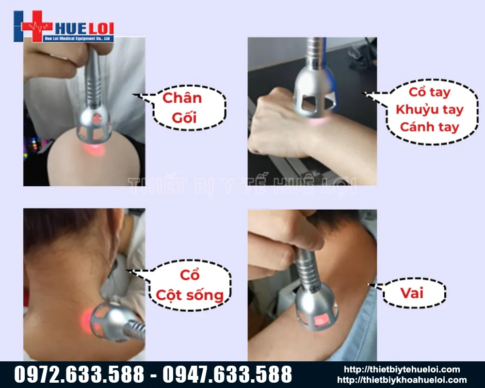 Vùng điều trị của máy laser đơn bước sóng