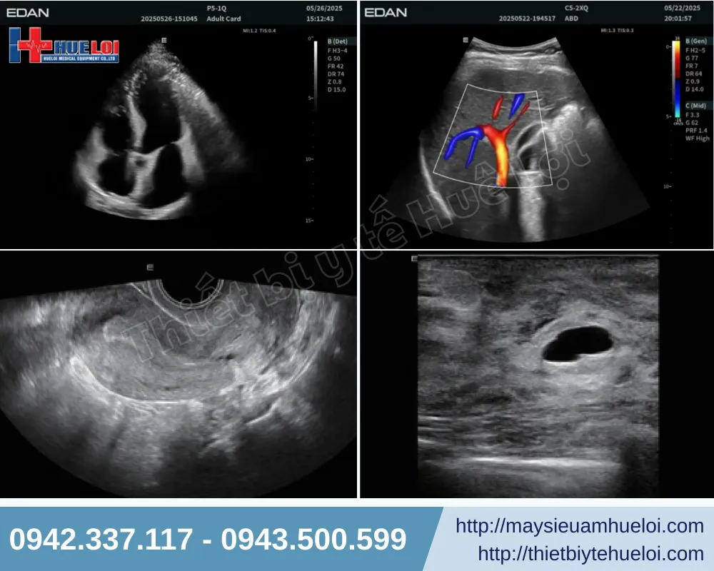 Chất lượng hình ảnh của máy siêu âm Acclarix LX85