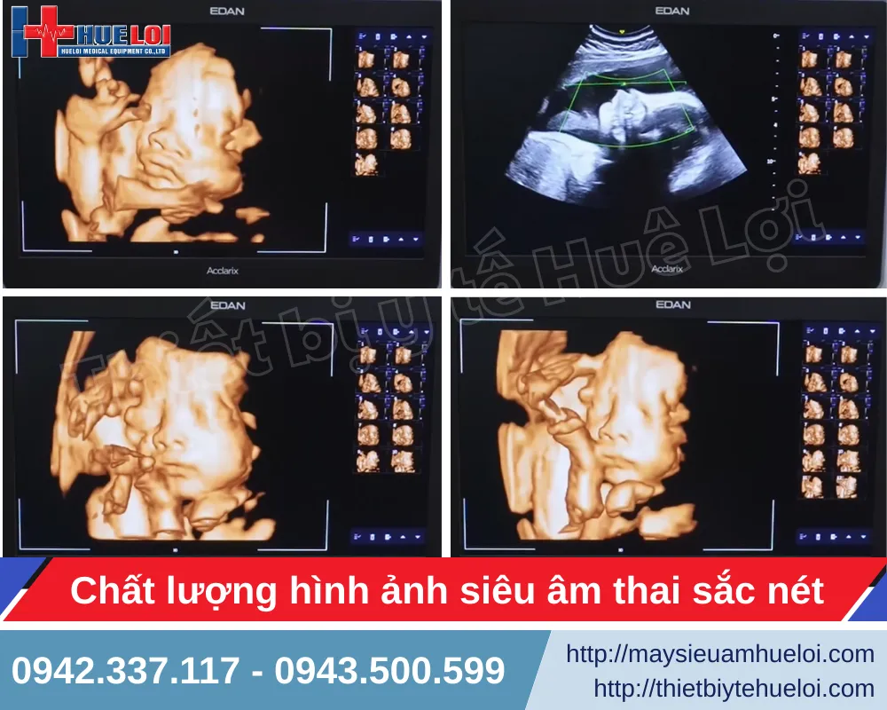 Hình ảnh siêu âm thai của máy siêu âm EDAN LX85