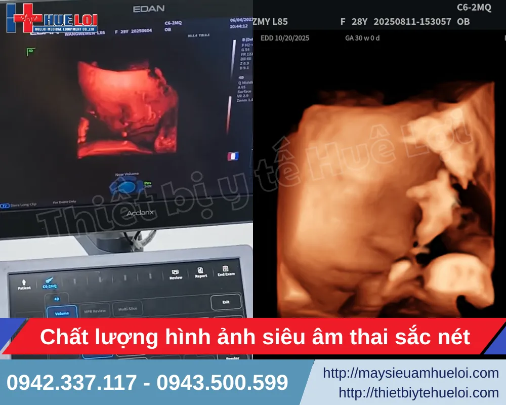 Hình ảnh của máy siêu âm Acclarix LX85