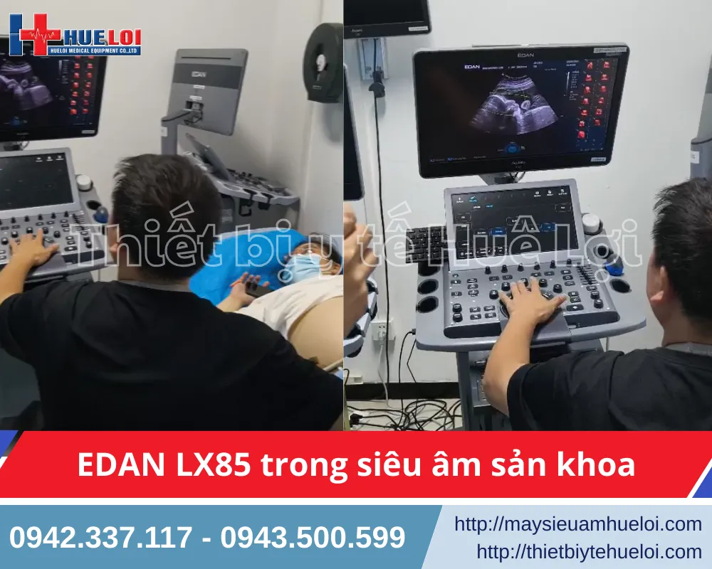 Trải nghiệm máy siêu âm EDAN LX85