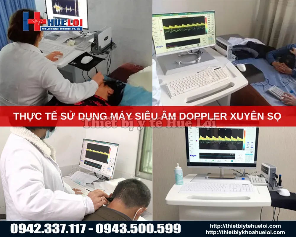 Trải nghiệm thực tế máy siêu âm doppler xuyên sọ