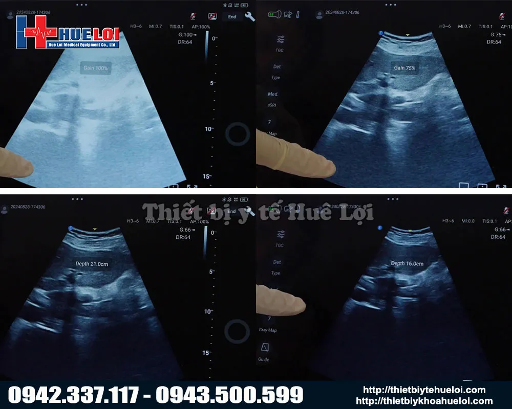 Chất lượng hình ảnh của máy siêu âm cầm tay