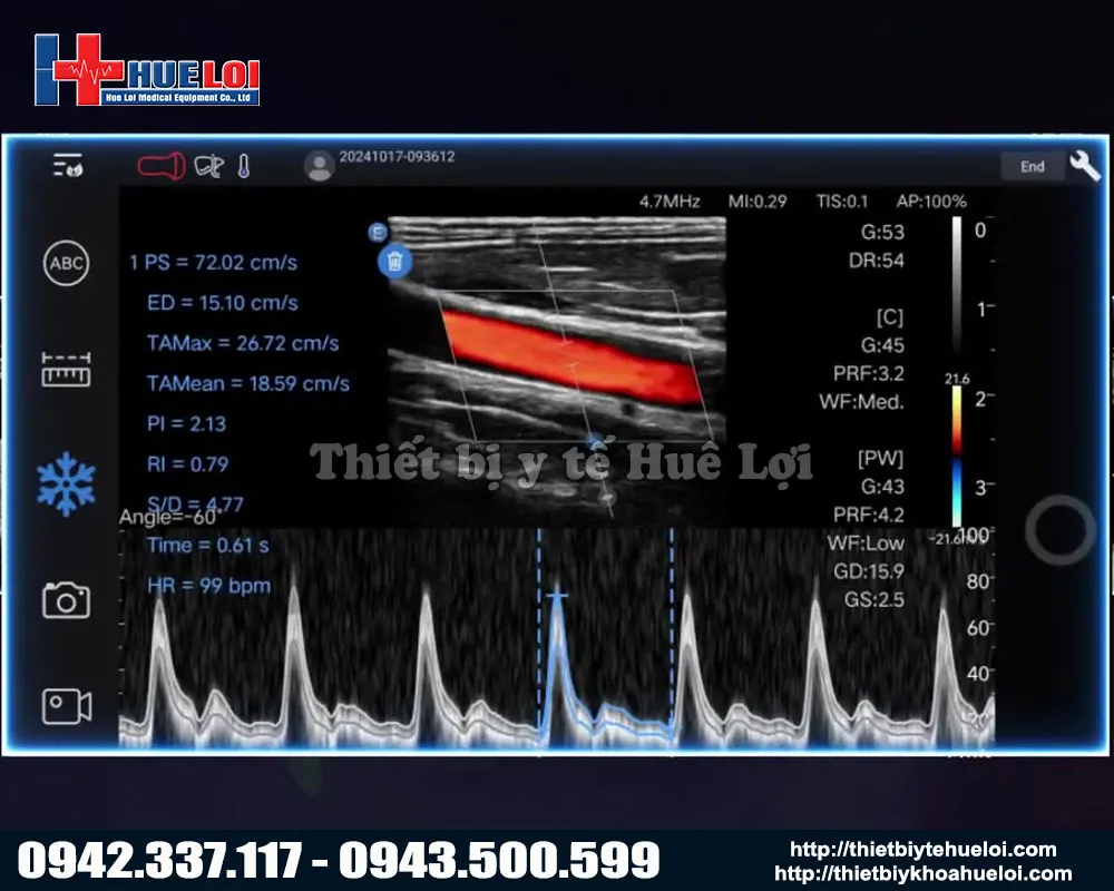Hình ảnh rõ nét của máy siêu âm cầm tay