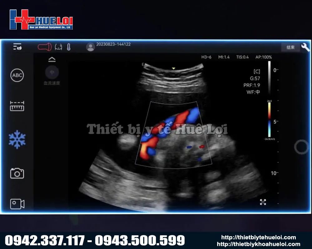 Chất lượng hình ảnh máy siêu âm di động Nano C5 Exp Edan