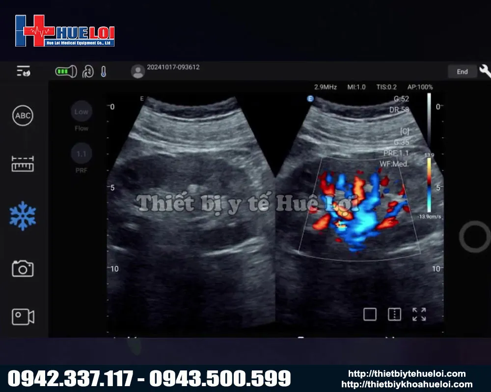 Hình ảnh của máy siêu âm di động Nano C5 Exp Edan