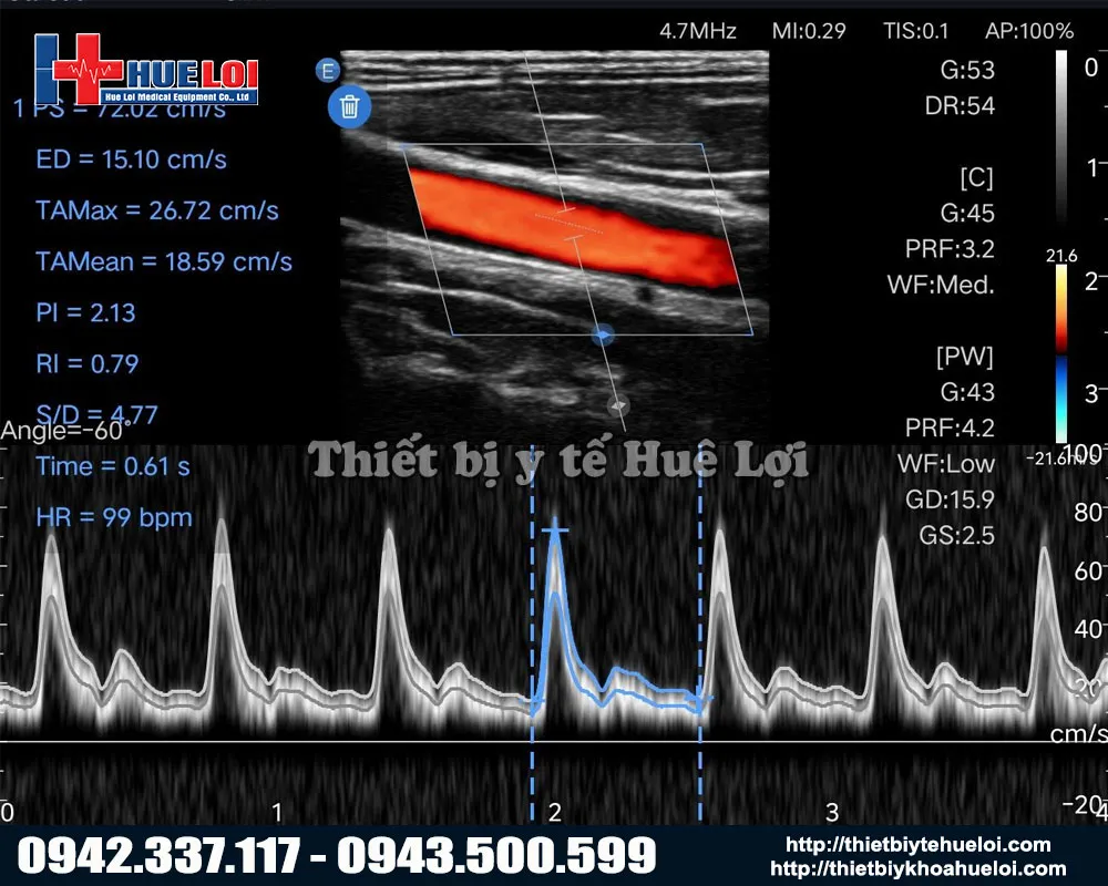 Hình ảnh chất lượng cao của máy chẩn đoán hình ảnh Edan L12