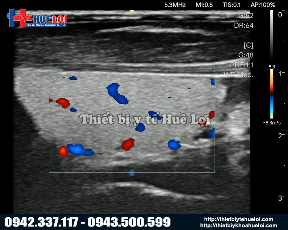 Hình ảnh chẩn đoán của máy siêu âm Edan L12