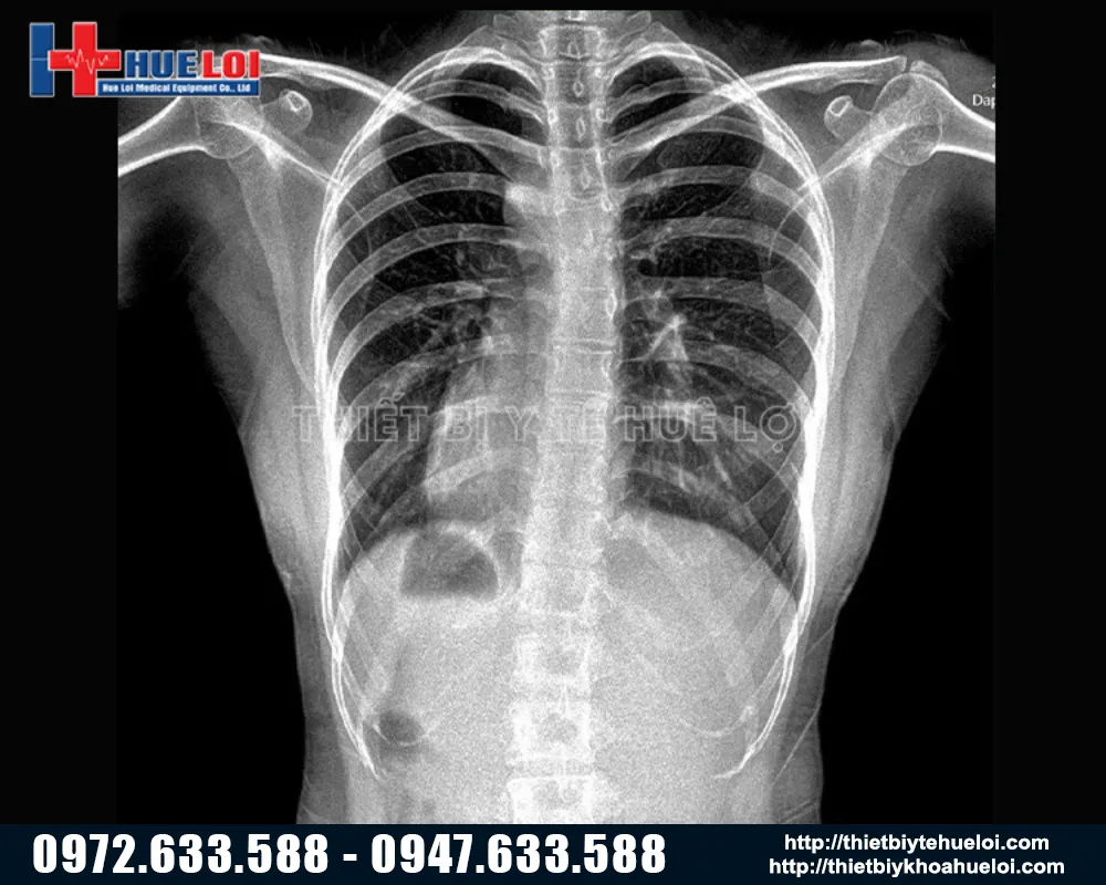 Chất lượng hình ảnh của máy X-Quang Yolong