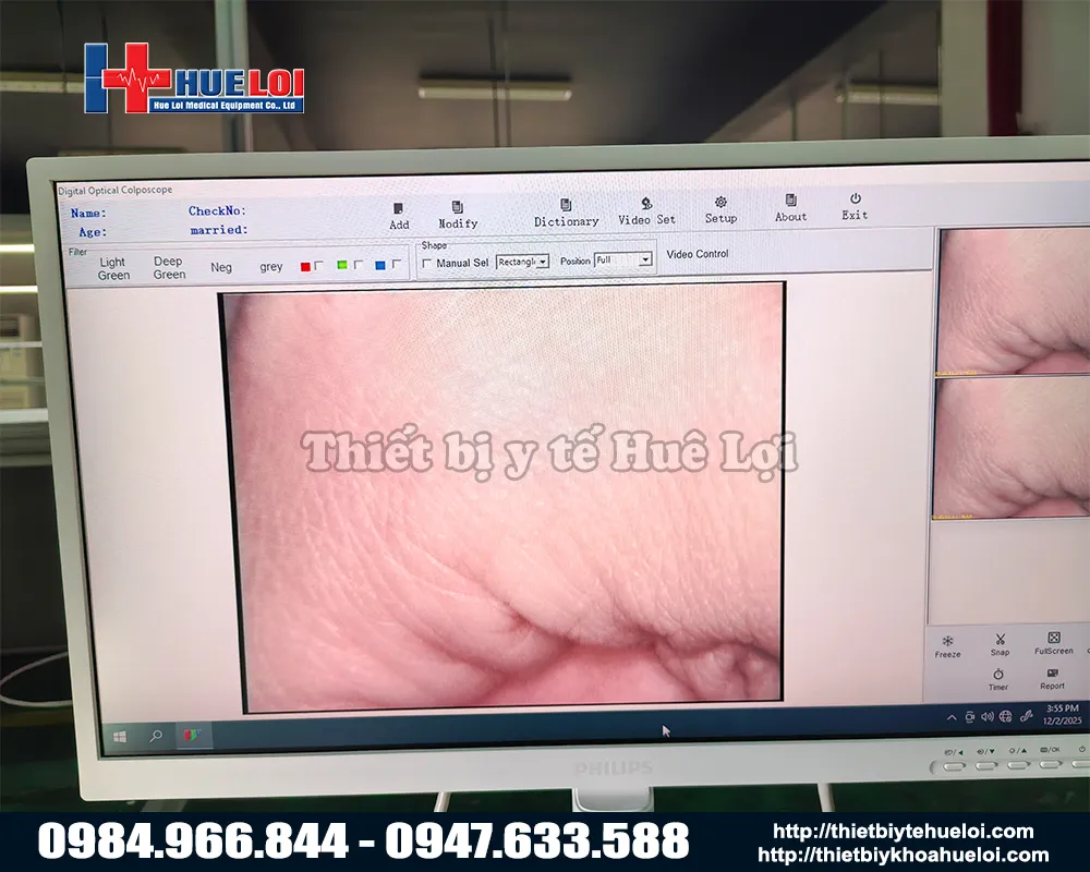 Hình ảnh của máy soi cổ tử cung sw304