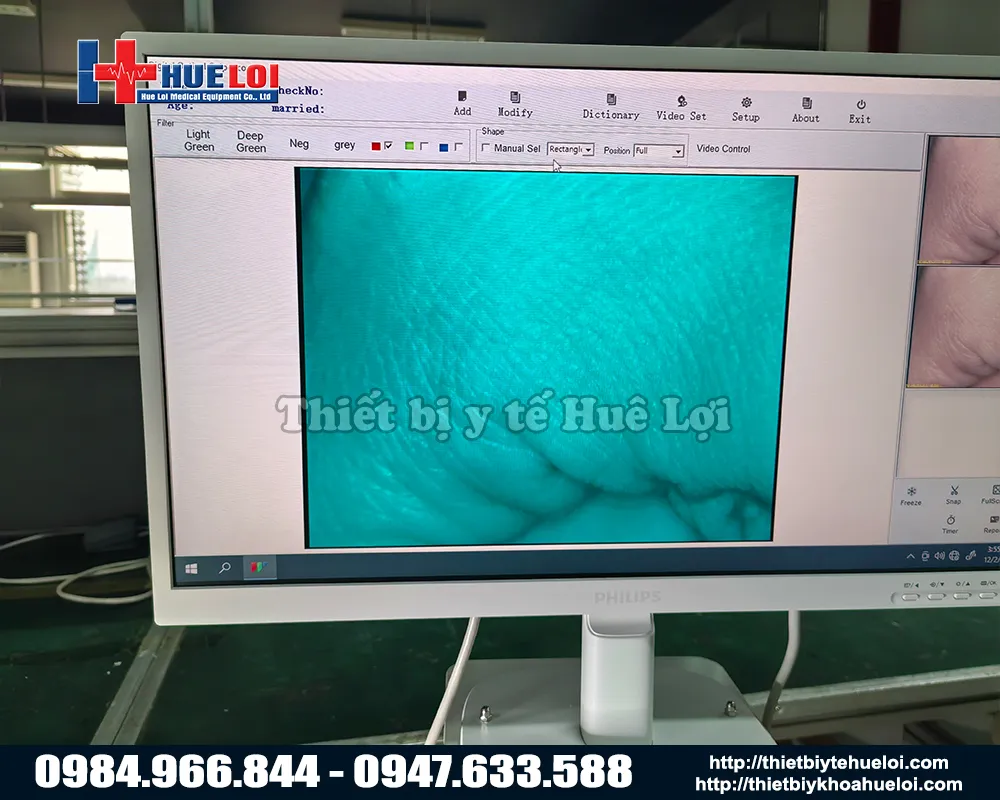 Hình ảnh thực tế của máy soi cổ tử cung sw304