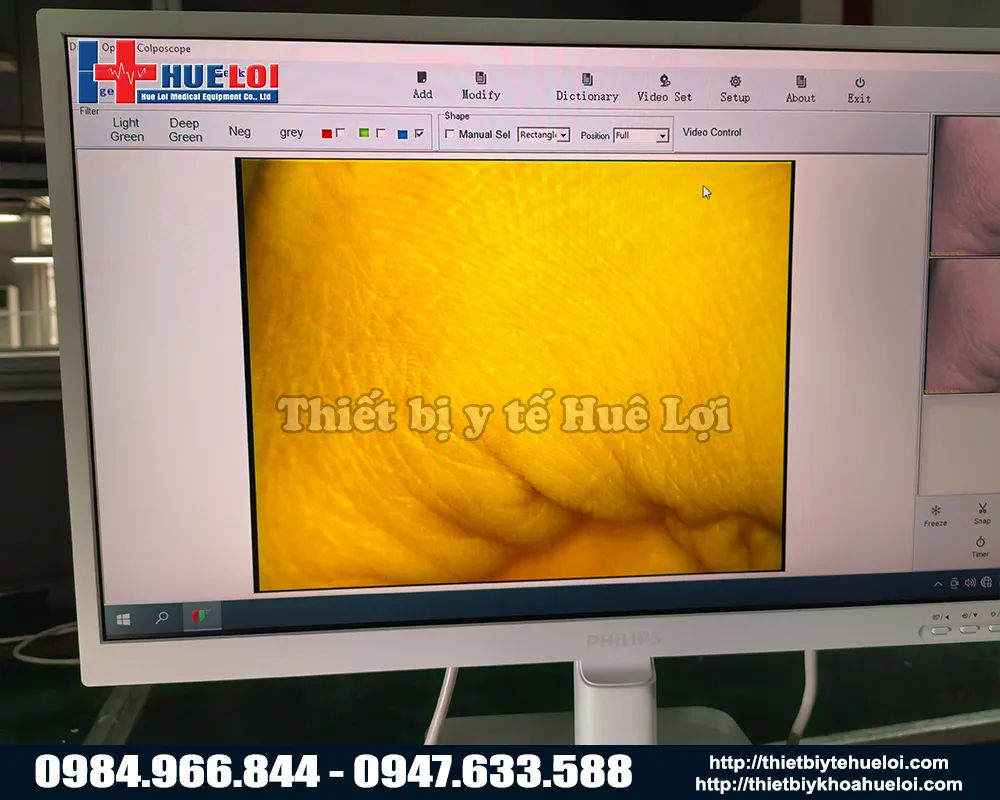 Chất lượng hình ảnh của máy soi cổ tử cung sw304